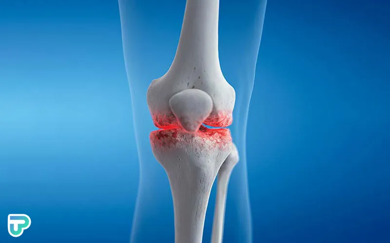درمان آرتروز زانو