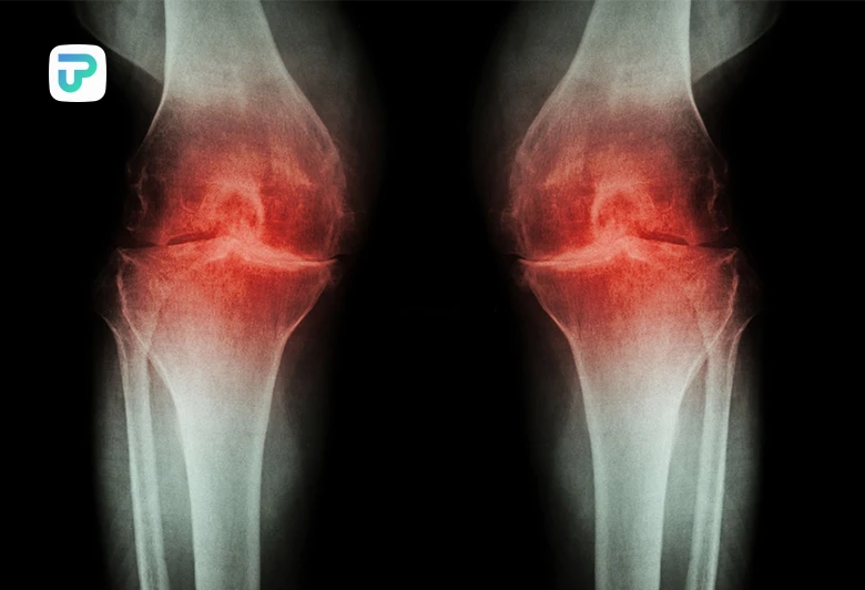 علت زانو درد هنگام نشستن و برخاستن| توان مارکت