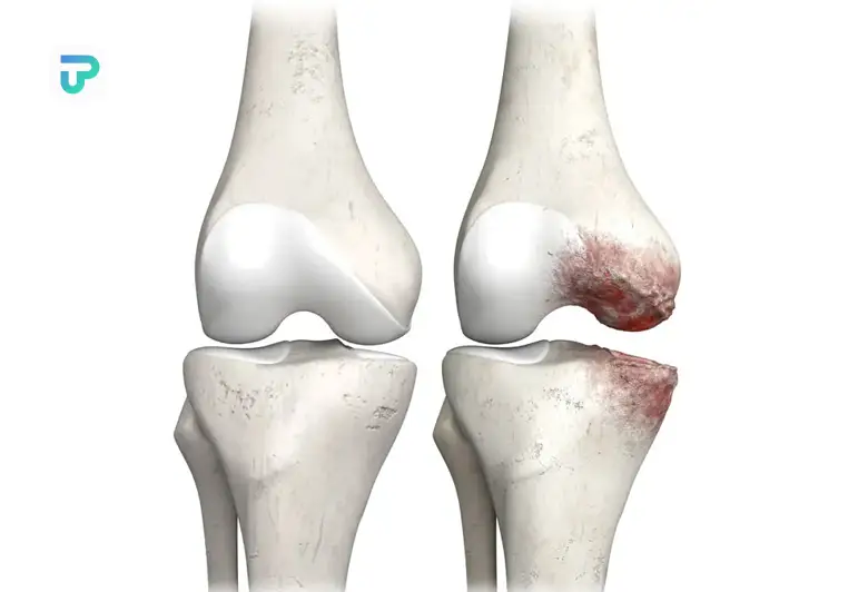 بهترین قرص برای آرتروز زانو چیست| توان مارکت