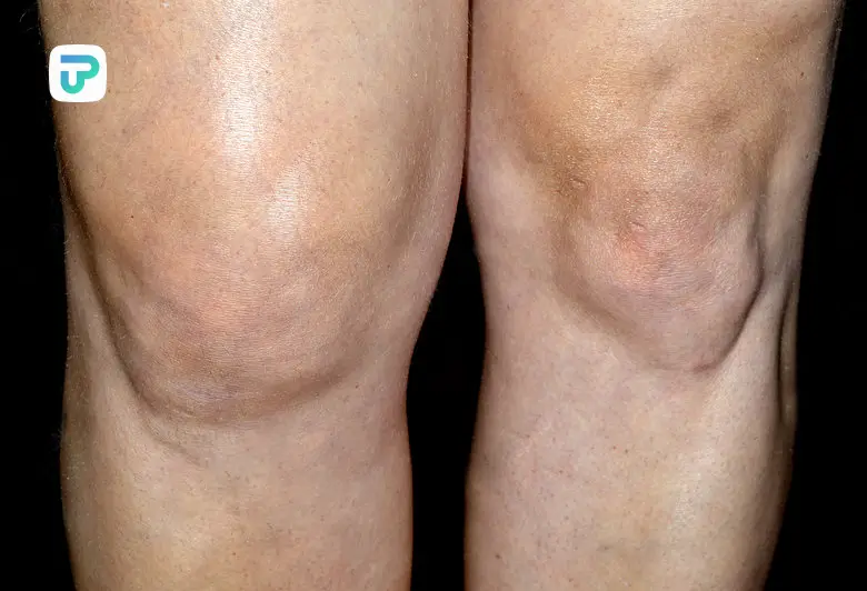 درمان ورم زانو در خانه با قرص ضد التهاب زانو | توان مارکت