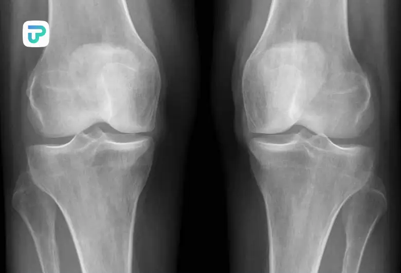 علت درد پا از زانو به پایین در شب | توان مارکت