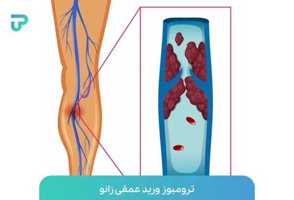 علت بی حس شدن پای چپ از زانو به پایین ؛ علت درد ران و ساق پا |توان مارکت