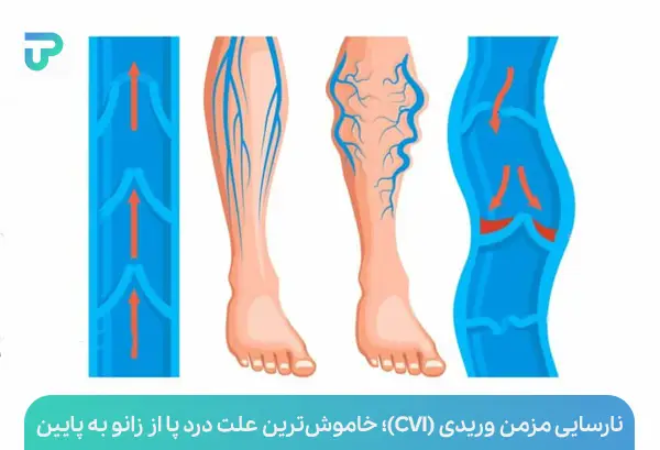 علت درد پا از زانو به پایین | توان مارکت