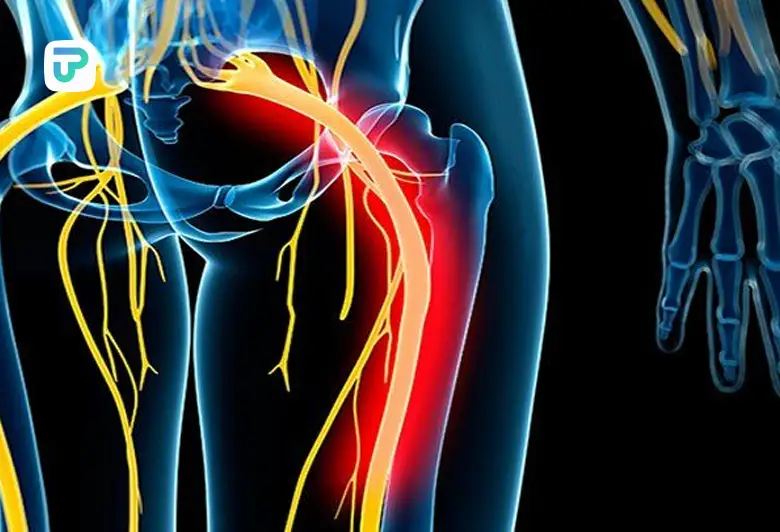 سیاتیک چیست و چه علائمی دارد | توان مارکت