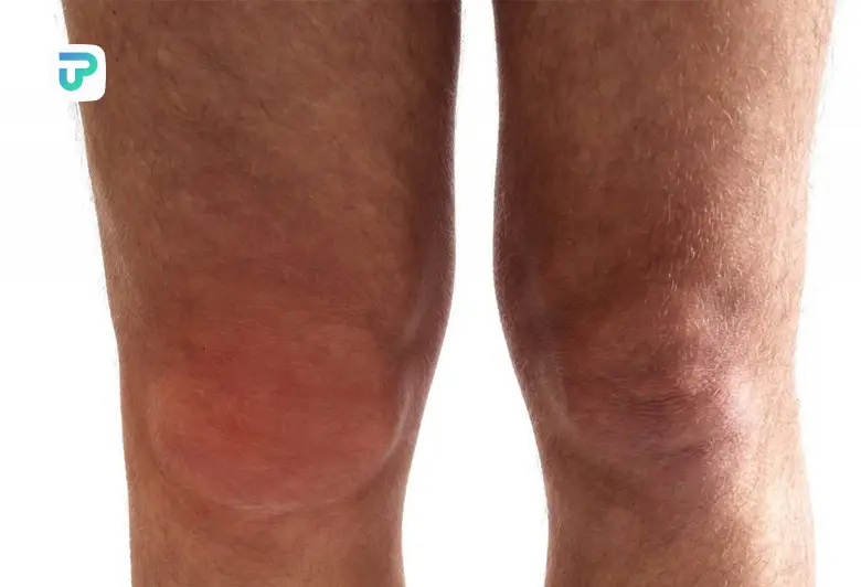 علت ورم زانو و درمان ورم زانو در خانه | توان مارکت