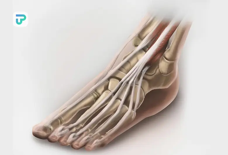 درد روی پا یا کیست گانگلیون روی پا | توان مارکت