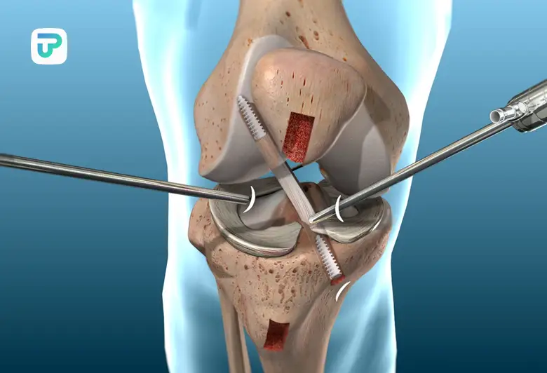 عمل جراحی زباط صلیبی دوره نقاهت بعد از عمل رباط صلیبی | توان مارکت