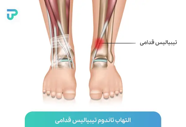 التهاب تاندوم تیبیالیس قدامی؛ عامل ایجاد درد روی پا یا درد تیغه بیرونی پا | توان مارکت