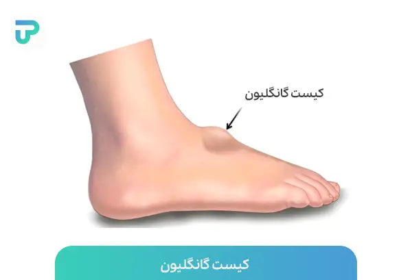 آیا علت درد پا از زانو به پایین ناشی از کیست گانگلیون روی پا است | توان مارکت