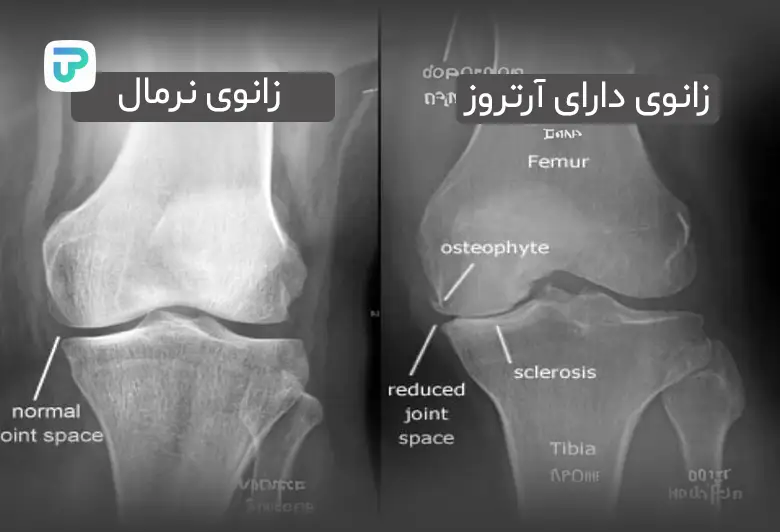 علائم آرتروز زانو در زنان | توان مارکت