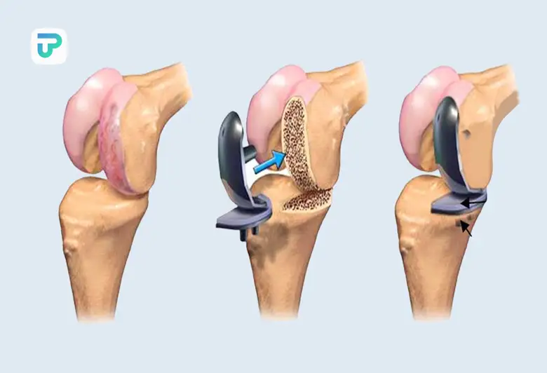 جدیدترین روش جراحی تعویض مفصل زانو چیست | توان مارکت