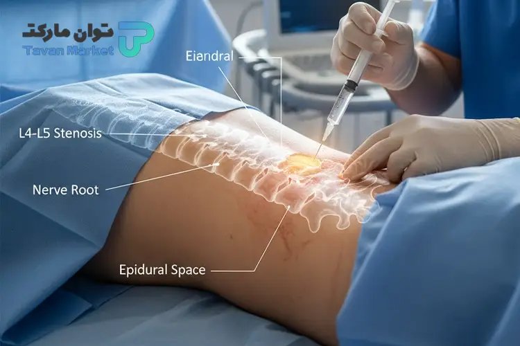 تزریق ژل برای تنگی کانال نخاعی