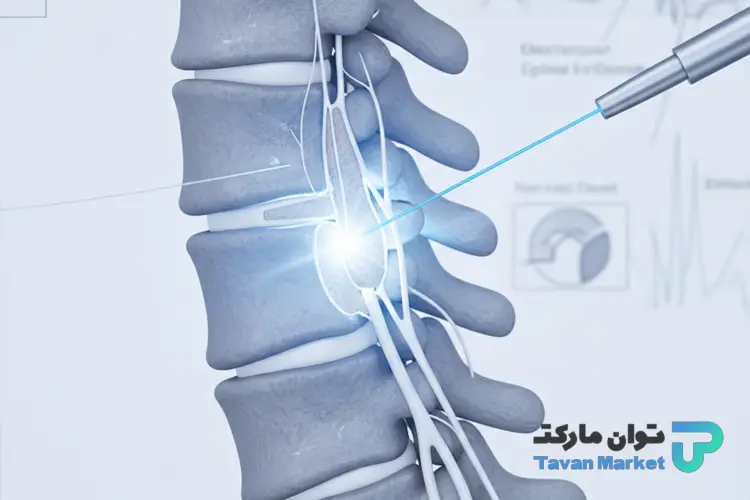 لیزر تنگی کانال نخاعی