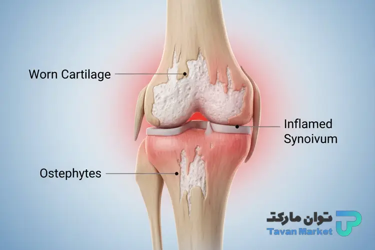 پماد برای آرتروز زانو