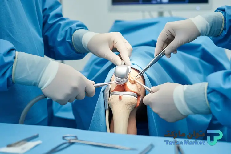 جراحی آرتروز زانو توان مارکت